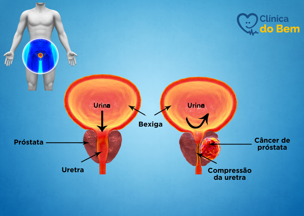 Signo y sintomas diferencia